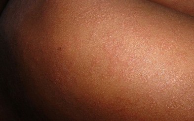 Bolile contagioase – Rujeola